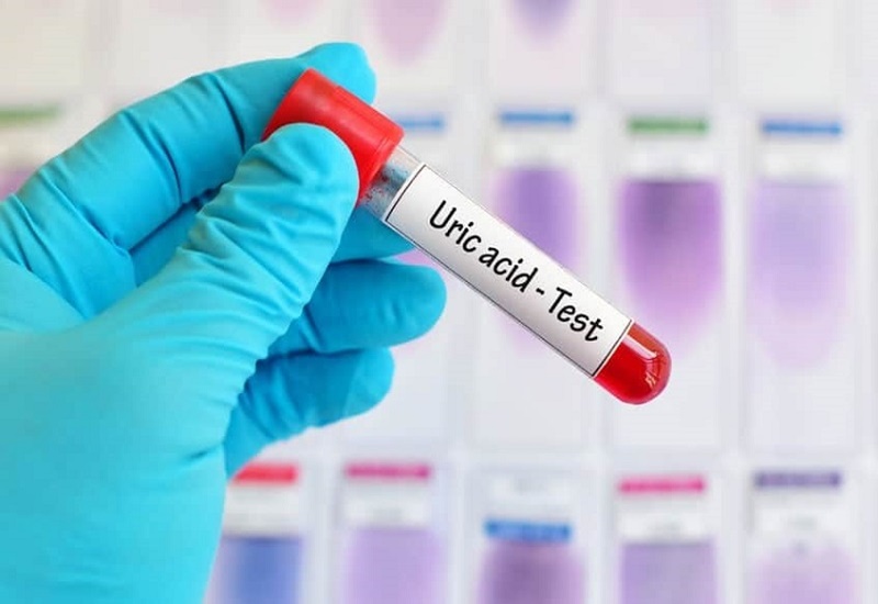 Xét nghiệm acid uric giúp theo giõi và chẩn đoán bệnh Gout