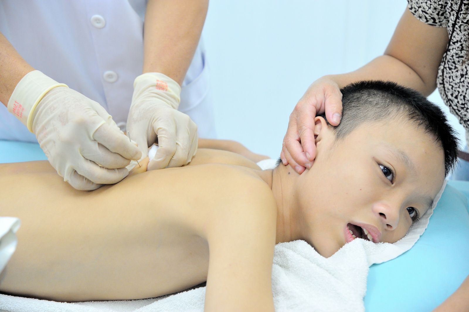 Châm cứu điều trị trẻ tự kỷ