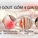 Dấu hiệu nhận biết gout