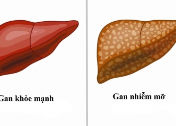 Chế độ ăn uống, bổ sung & lối sống cho người mắc gan nhiễm mỡ
