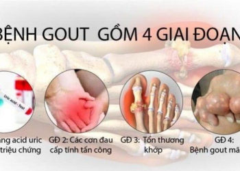 Dấu hiệu nhận biết gout