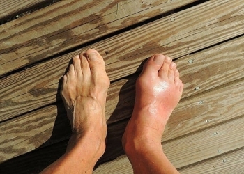 Tại sao gout nặng hơn về đêm?