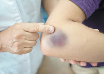 Dấu hiệu nhận biết suy giảm chức năng gan